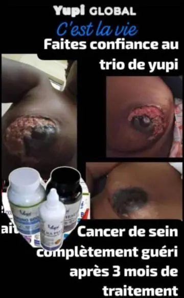 Témoignage Yupi Global cas Cancer du sein