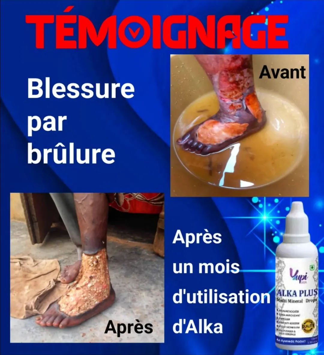 Témoignage Yupi Global, brûlure 